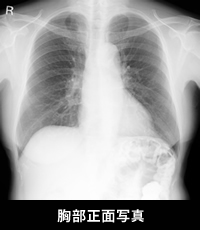 胸部正面写真