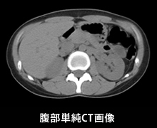 腹部単純CT画像