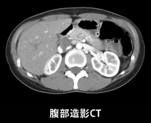 腹部造影CT
