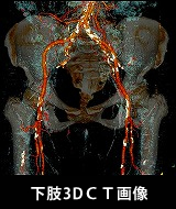 下肢3DCT画像