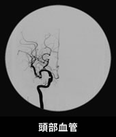 頭部血管
