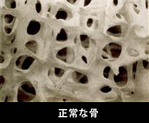 正常な骨
