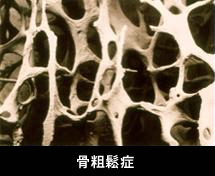 骨粗鬆症